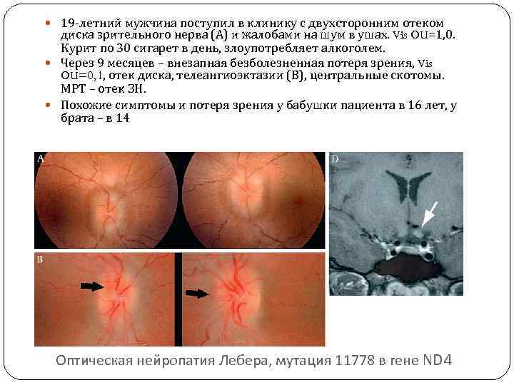  19 -летний мужчина поступил в клинику с двухсторонним отеком диска зрительного нерва (А)