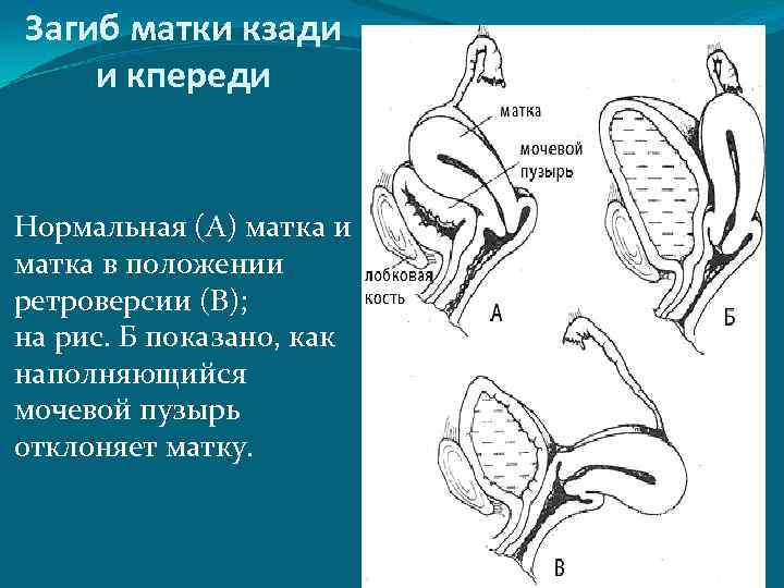 Загиб матки кзади и кпереди Нормальная (А) матка и матка в положении ретроверсии (В);