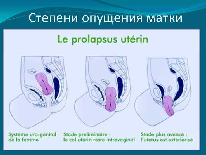 Степени опущения матки 