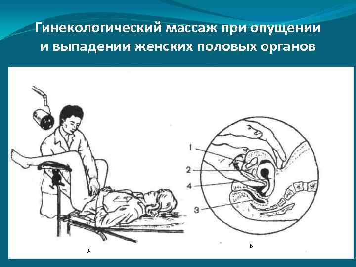 Гинекологический массаж при опущении и выпадении женских половых органов 