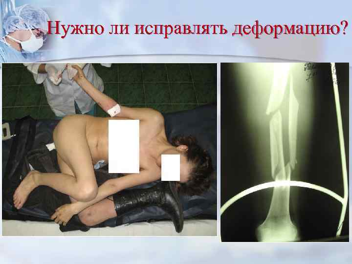 Нужно ли исправлять деформацию? 