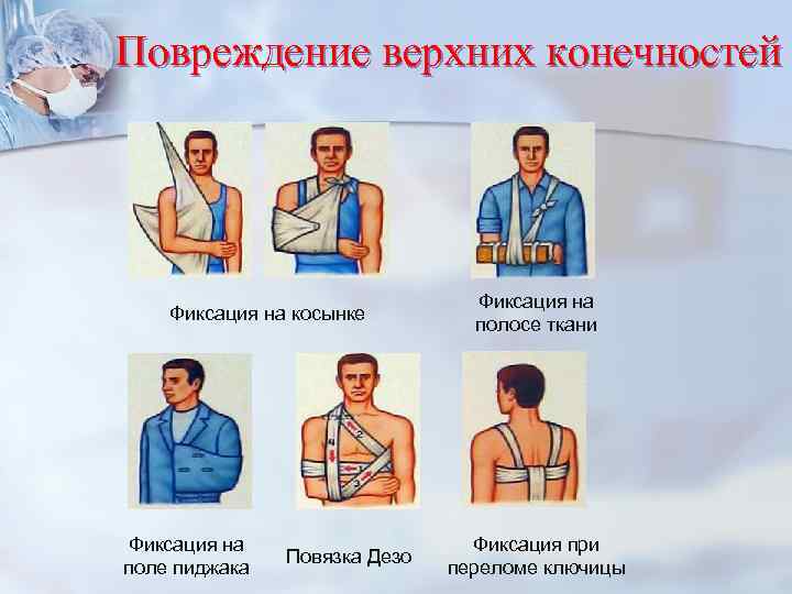 Повреждение верхних конечностей Фиксация на поле пиджака Повязка Дезо Фиксация на полосе ткани Фиксация