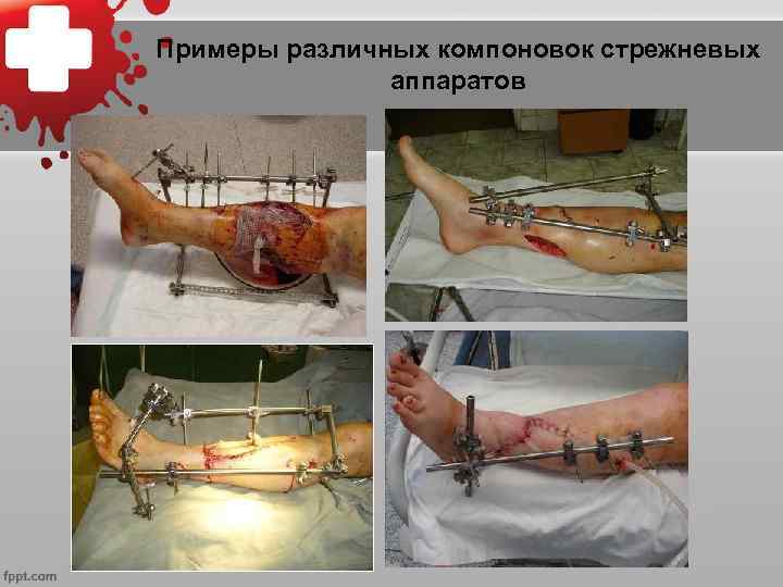 Примеры различных компоновок стрежневых аппаратов 