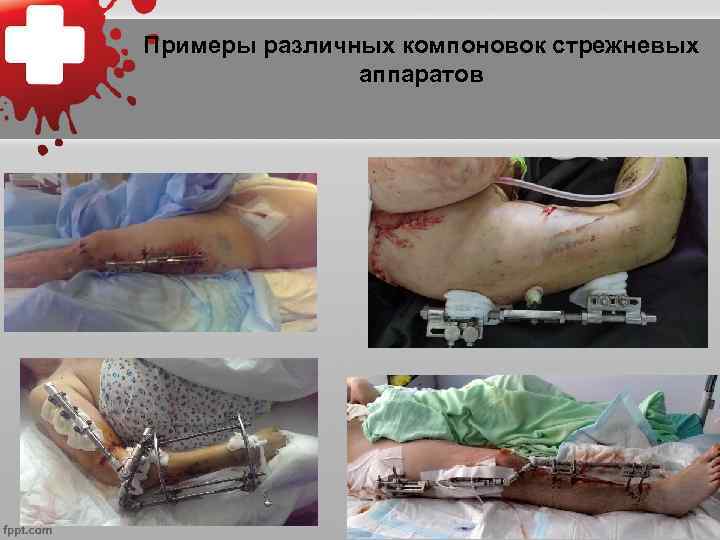 Примеры различных компоновок стрежневых аппаратов 