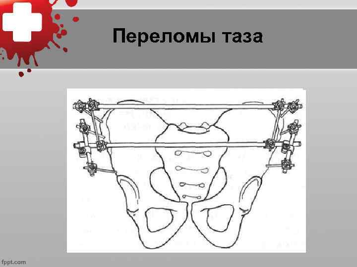 Переломы таза 