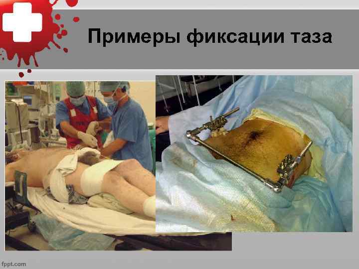 Примеры фиксации таза 