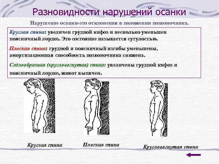 Разновидности нарушений осанки Нарушение осанки-это отклонения в положении позвоночника. Круглая спина: увеличен грудной кифоз