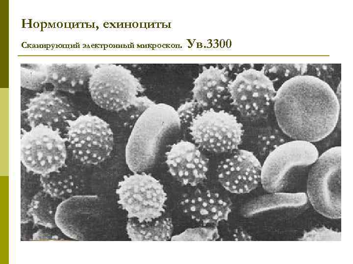 Нормоциты, ехиноциты Сканирующий электронный микроскоп. Ув. 3300 