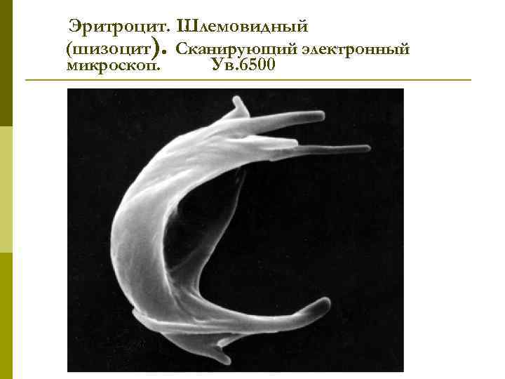 Эритроцит. Шлемовидный (шизоцит). Сканирующий электронный микроскоп. Ув. 6500 