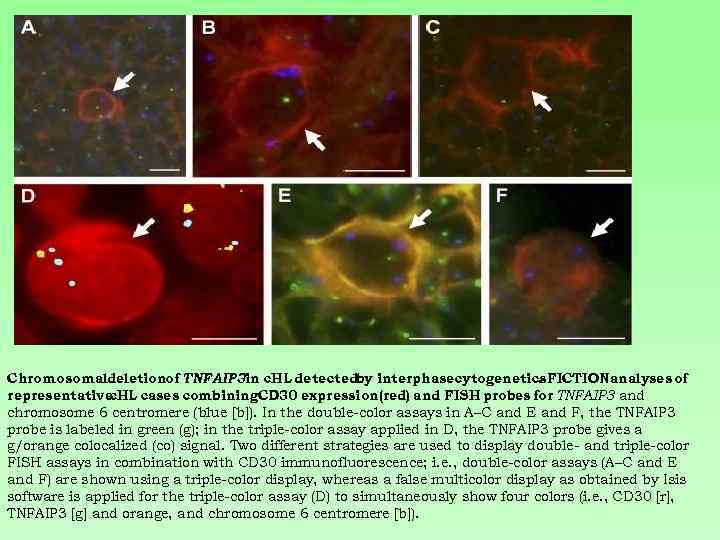 Chromosomaldeletionof TNFAIP 3 in c. HL detectedby interphasecytogenetics. FICTION analyses of. representative c. HL