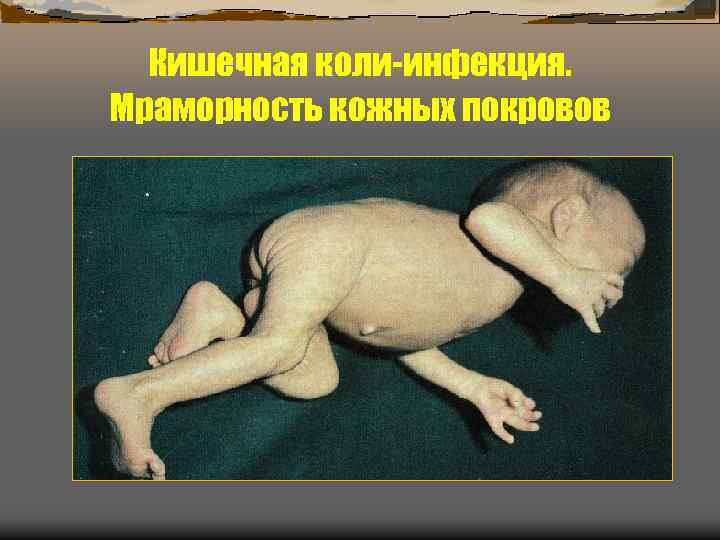 Кишечная коли-инфекция. Мраморность кожных покровов 