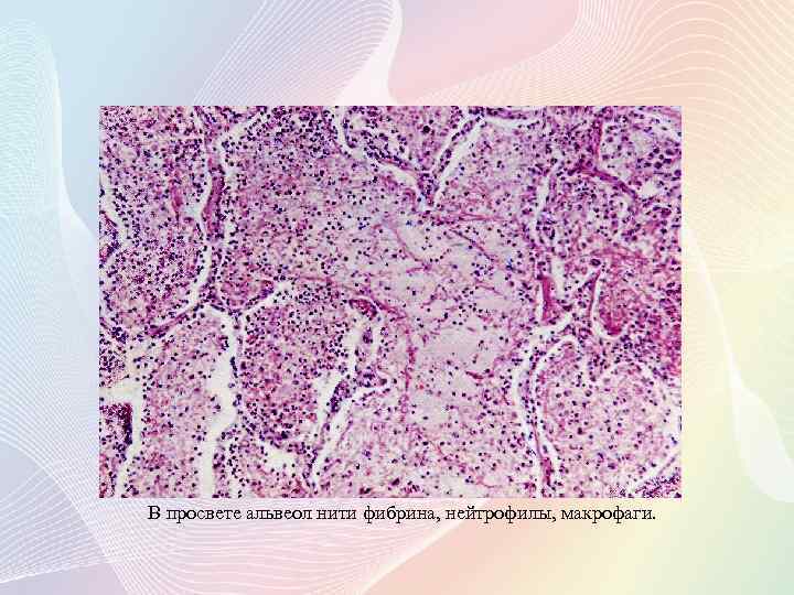 В просвете альвеол нити фибрина, нейтрофилы, макрофаги. 