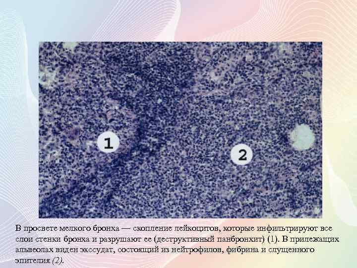 В просвете мелкого бронха — скопление лейкоцитов, которые инфильтрируют все слои стенки бронха и