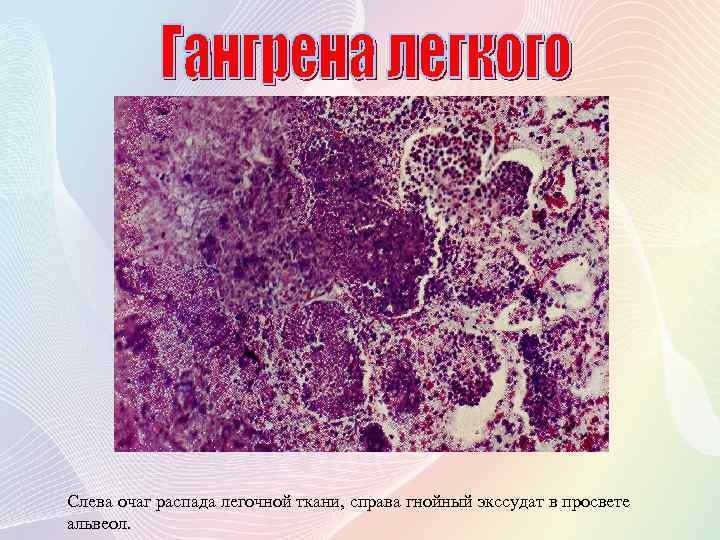 Слева очаг распада легочной ткани, справа гнойный экссудат в просвете альвеол. 
