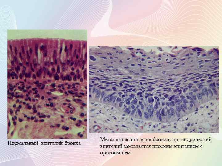Группы клеток метаплазированного. Метаплазия бронхиального эпителия микропрепарат. Метапластический цилиндрический эпителий.