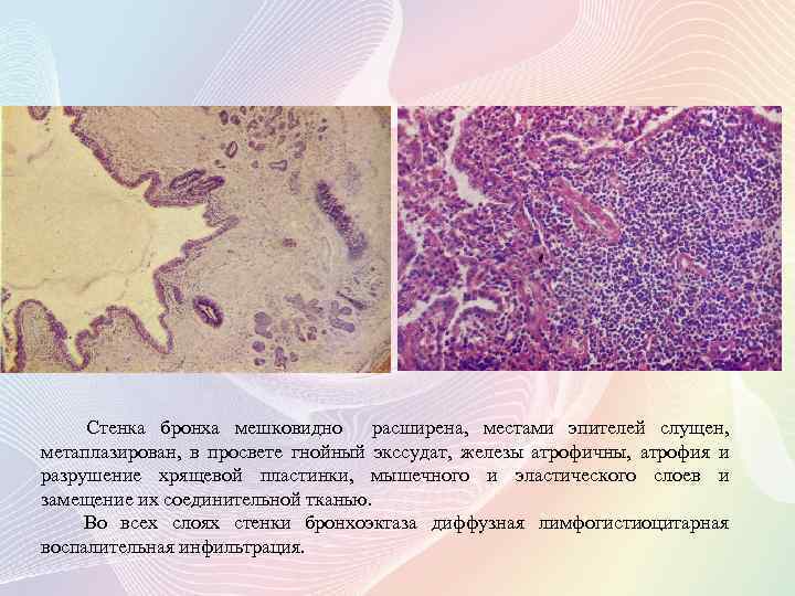 Стенка бронха мешковидно расширена, местами эпителей слущен, метаплазирован, в просвете гнойный экссудат, железы атрофичны,