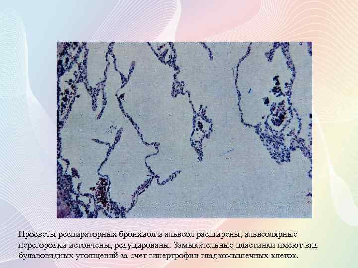 Просветы респираторных бронхиол и альвеол расширены, альвеолярные перегородки истончены, редуцированы. Замыкательные пластинки имеют вид