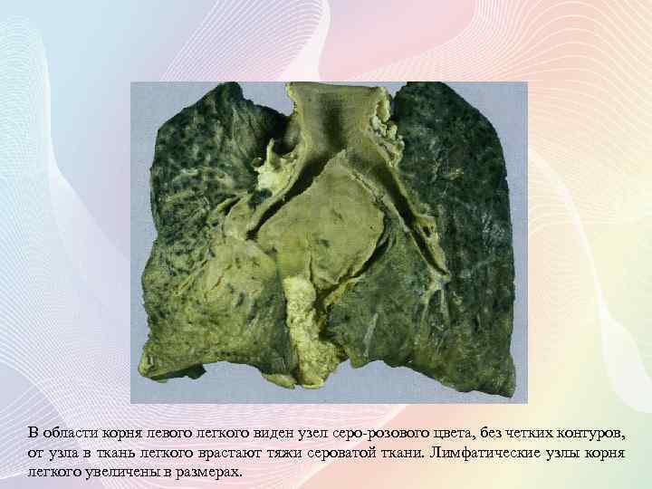 В области корня левого легкого виден узел серо-розового цвета, без четких контуров, от узла
