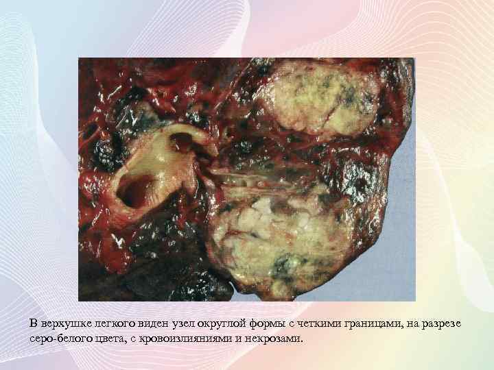В верхушке легкого виден узел округлой формы с четкими границами, на разрезе серо-белого цвета,