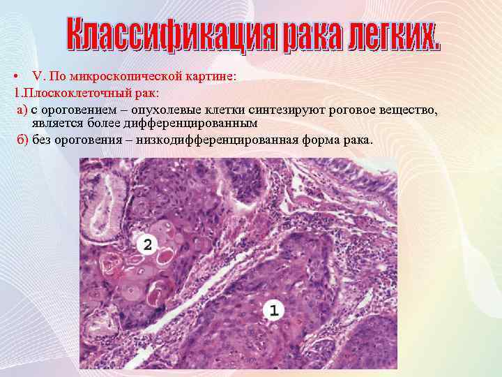  • V. По микроскопической картине: 1. Плоскоклеточный рак: а) с ороговением – опухолевые