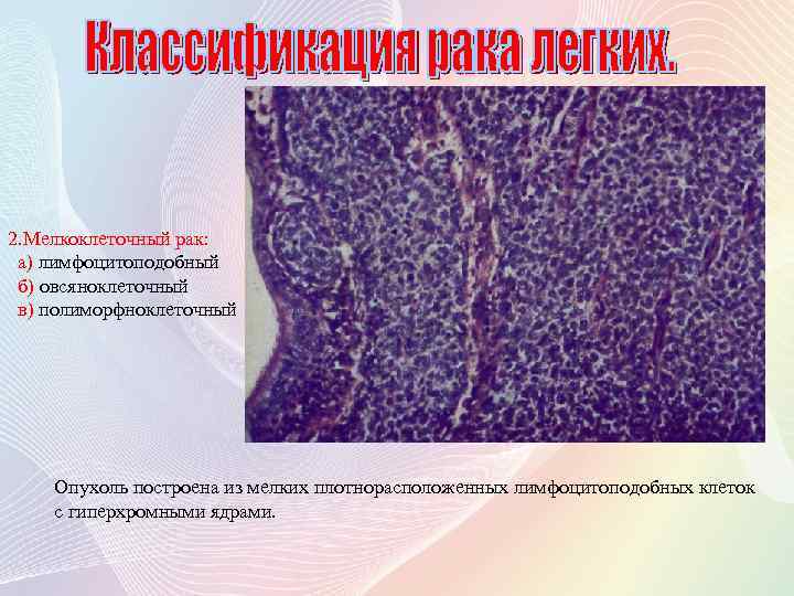 2. Мелкоклеточный рак: а) лимфоцитоподобный б) овсяноклеточный в) полиморфноклеточный Опухоль построена из мелких плотнорасположенных