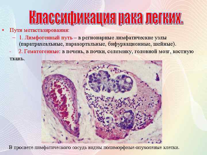  • Пути метастазирования: – 1. Лимфогенный путь – в регионарные лимфатические узлы (паратрахеальные,