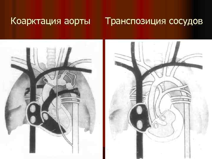 Коарктация аорты Транспозиция сосудов 