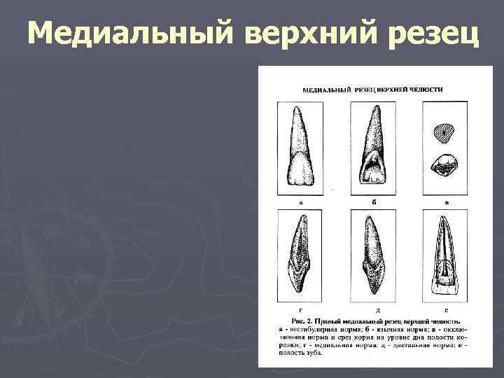 Медиальный верхний резец 