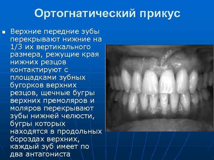 Ортогнатический прикус n Верхние передние зубы перекрывают нижние на 1/3 их вертикального размера, режущие