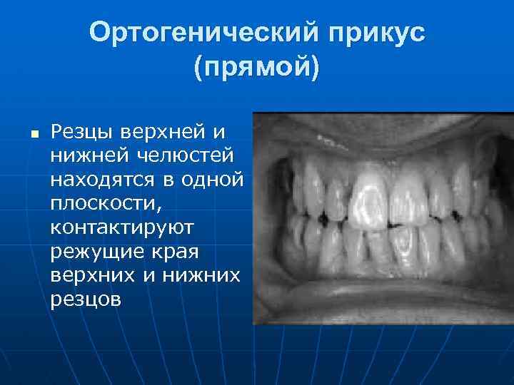 Ортогенический прикус (прямой) n Резцы верхней и нижней челюстей находятся в одной плоскости, контактируют