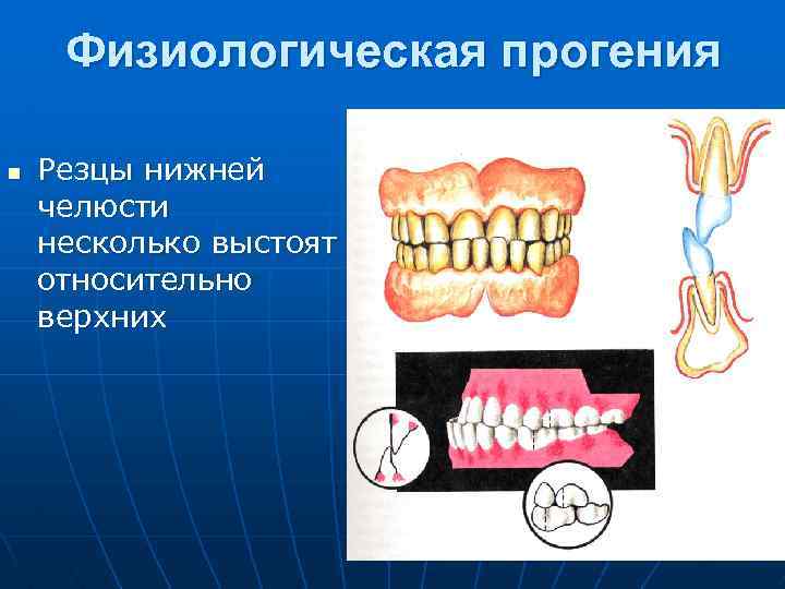 Прогения нижней. Физиологическая прогения. Прогенический физиологический прикус. Прогенический прикус постановка. Прогеническое соотношение челюстей.