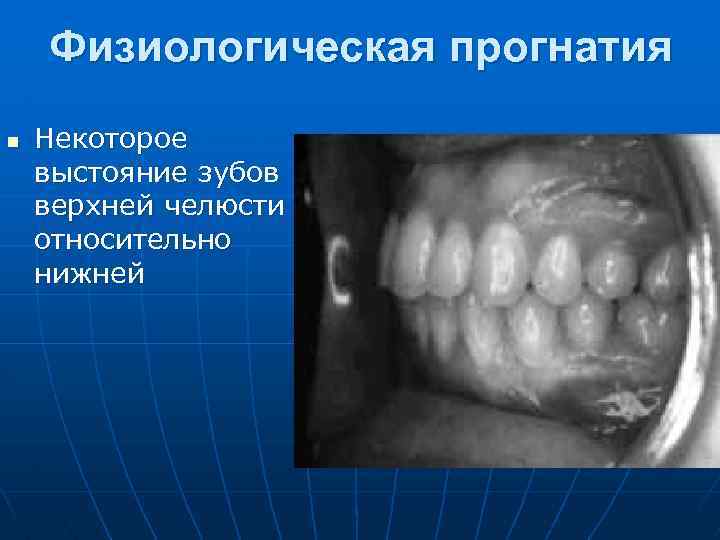 Физиологическая прогнатия n Некоторое выстояние зубов верхней челюсти относительно нижней 