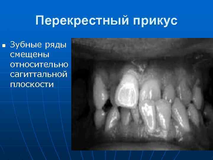 Перекрестный прикус n Зубные ряды смещены относительно сагиттальной плоскости 