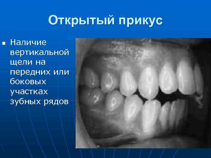 Открытый прикус. Боковой открытый прикус. Передний и боковой открытый прикус.