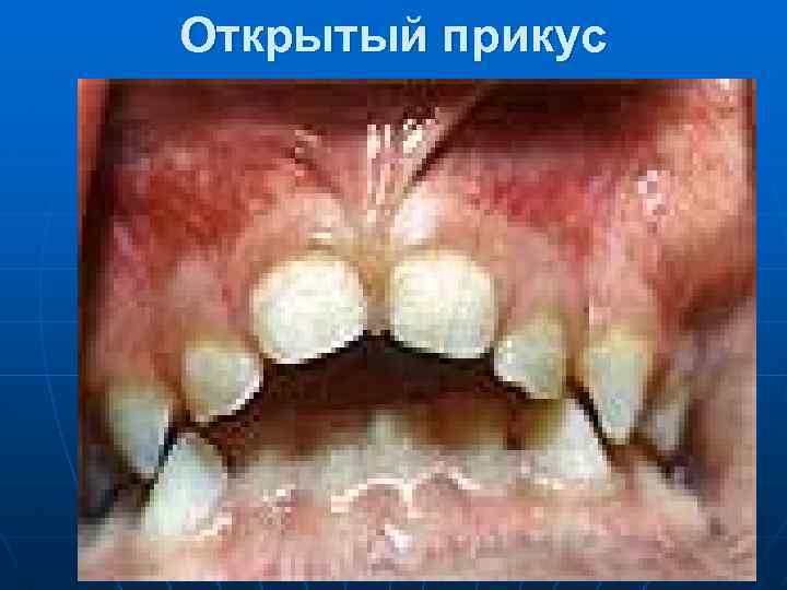 Открытый прикус 