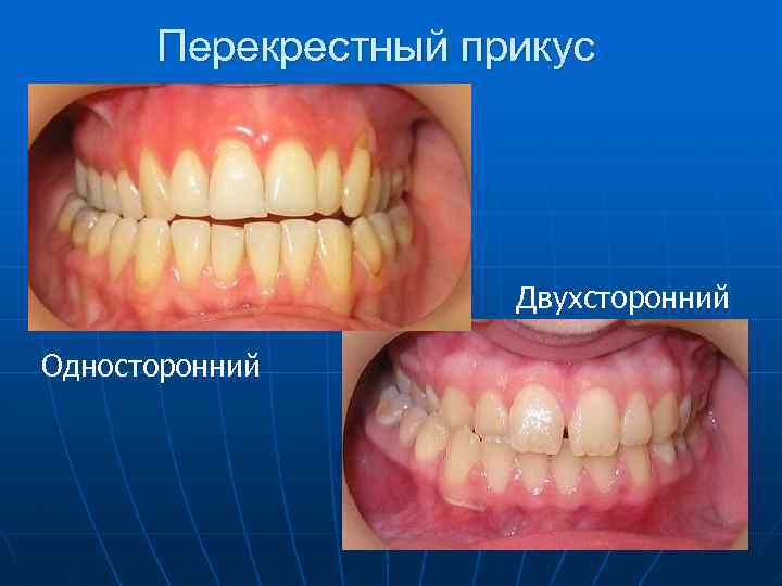 Перекрестный прикус Двухсторонний Односторонний 