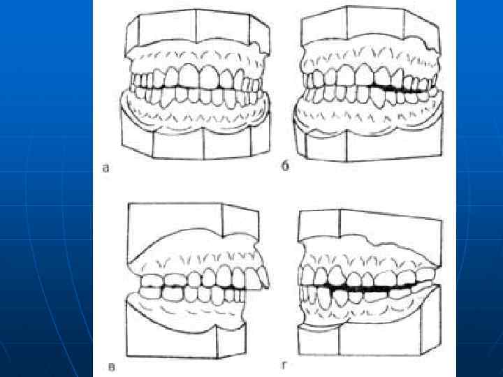 Боковая окклюзия. Артикуляция окклюзия прикус. Передняя окклюзия зубных рядов. Окклюзии артикуляция и окклюзия. Артикуляция окклюзия и прикус зубов.
