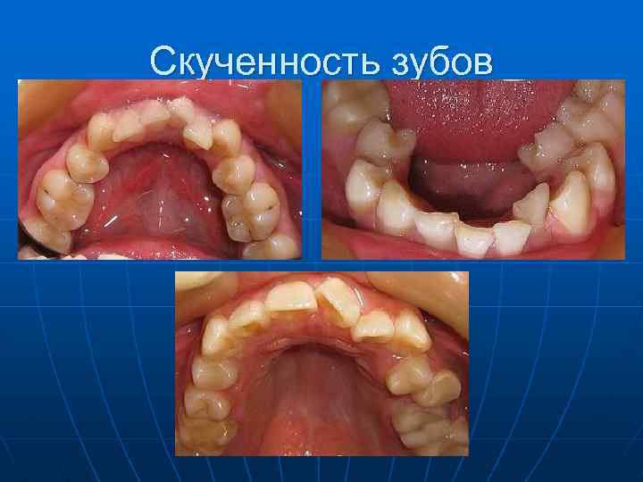 Скученность зубов 