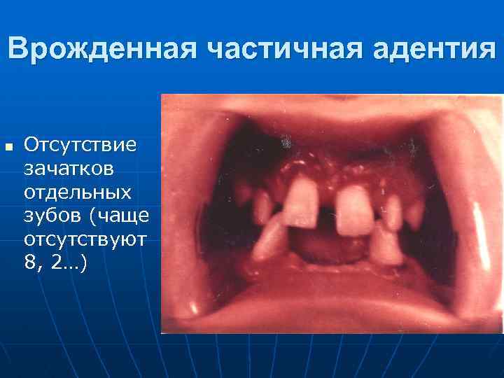 Врожденная частичная адентия n Отсутствие зачатков отдельных зубов (чаще отсутствуют 8, 2…) 