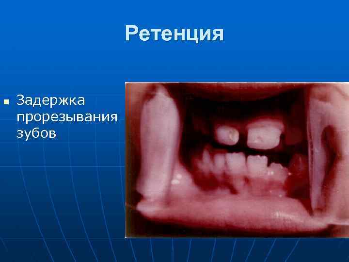 Ретенция n Задержка прорезывания зубов 