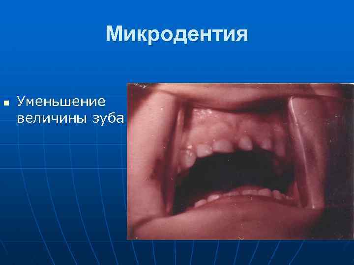 Микродентия n Уменьшение величины зуба 