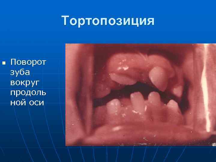 Тортопозиция n Поворот зуба вокруг продоль ной оси 