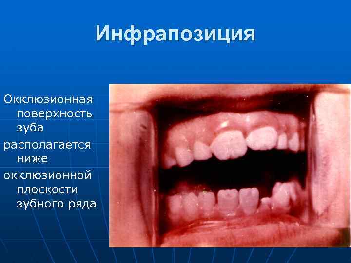 Инфрапозиция Окклюзионная поверхность зуба располагается ниже окклюзионной плоскости зубного ряда 