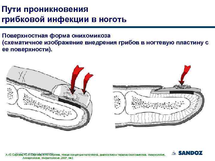 Пути проникновения грибковой инфекции в ноготь Поверхностная форма онихомикоза (схематичное изображение внедрения грибов в