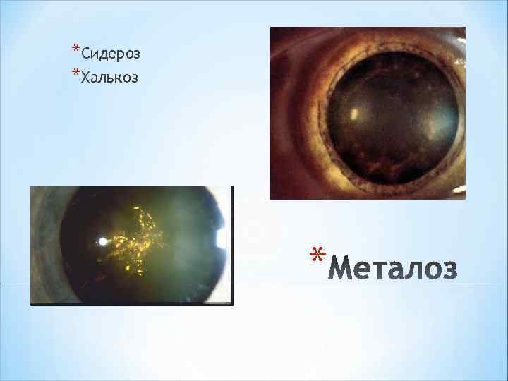 *Сидероз *Халькоз * 