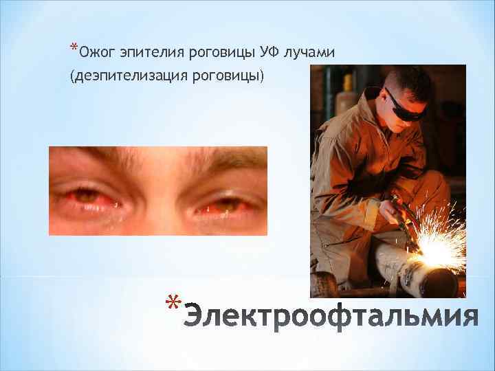 *Ожог эпителия роговицы УФ лучами (деэпителизация роговицы) * 