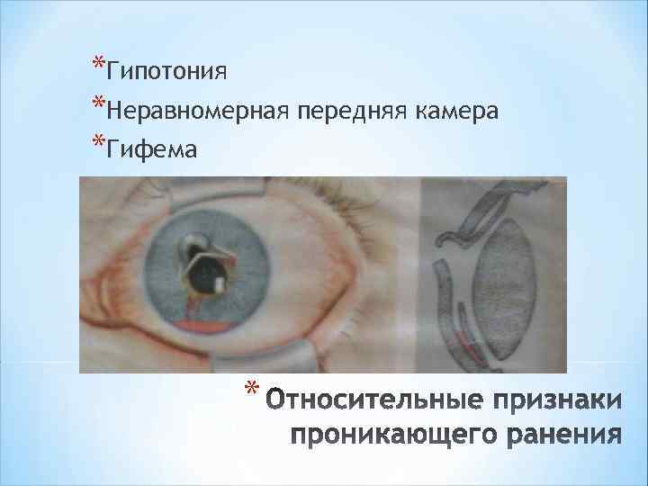 *Гипотония *Неравномерная передняя камера *Гифема * 