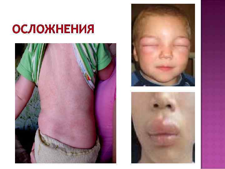 ОСЛОЖНЕНИЯ 