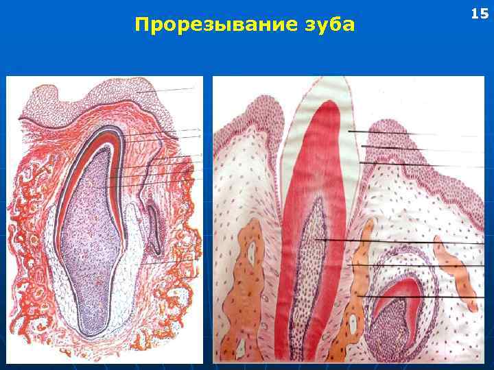 Прорезывание зуба 15 