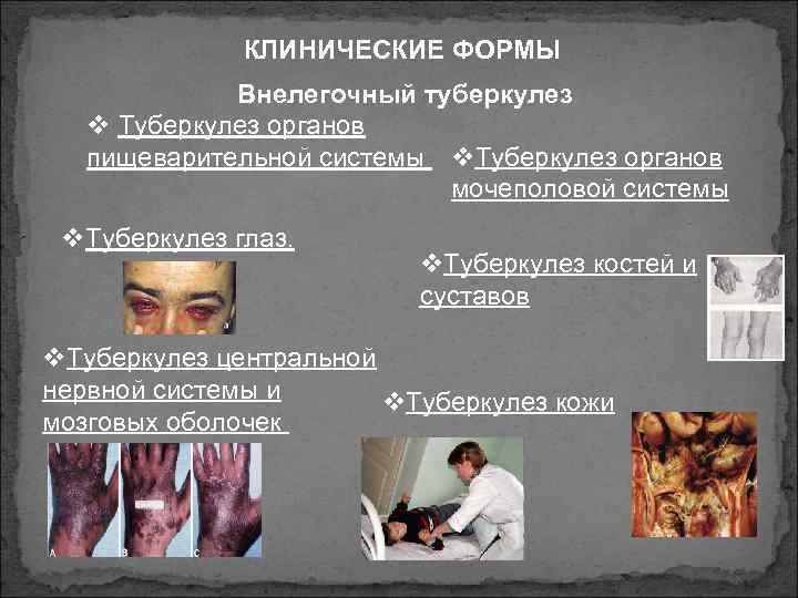 КЛИНИЧЕСКИЕ ФОРМЫ Внелегочный туберкулез v Туберкулез органов пищеварительной системы v. Туберкулез органов мочеполовой системы